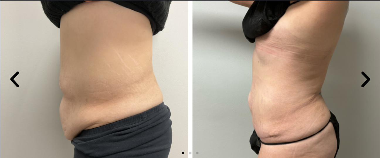 tummytuck2