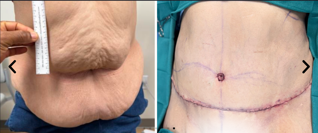 tummytuck3